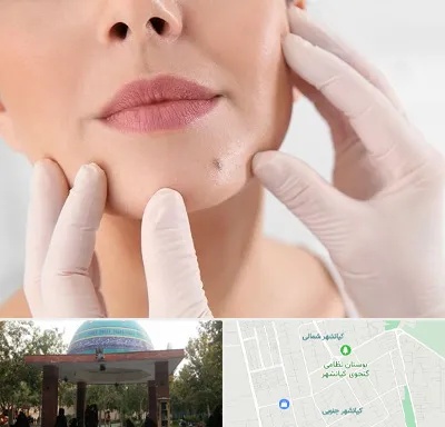 برداشتن خال در کیانشهر