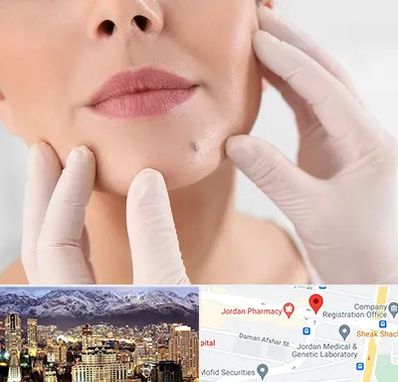 برداشتن خال در جردن 