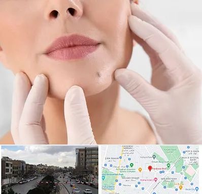 برداشتن خال در بلوار فردوسی مشهد