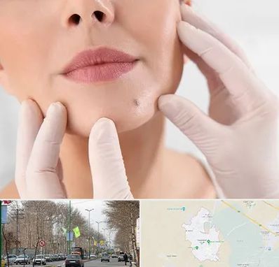 برداشتن خال در نظرآباد کرج