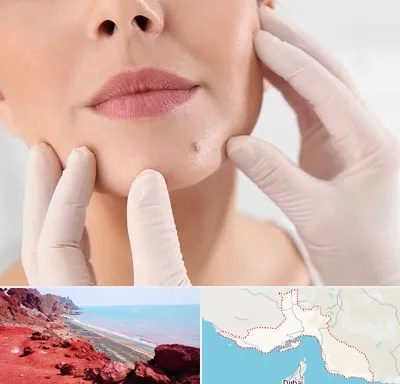 برداشتن خال در هرمزگان