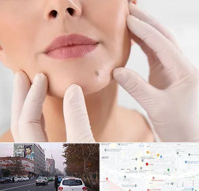 برداشتن خال در کارگر شمالی