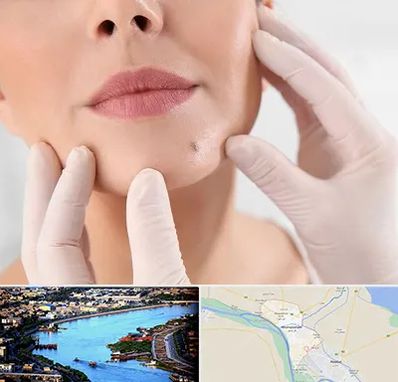 برداشتن خال در خرمشهر