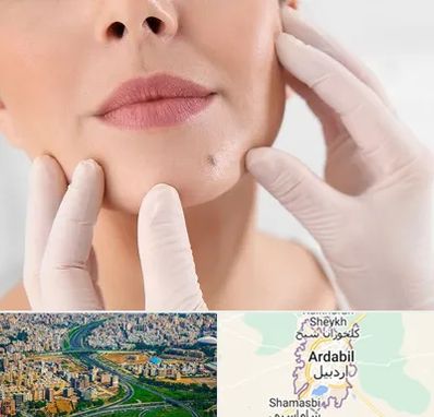 برداشتن خال در اردبیل