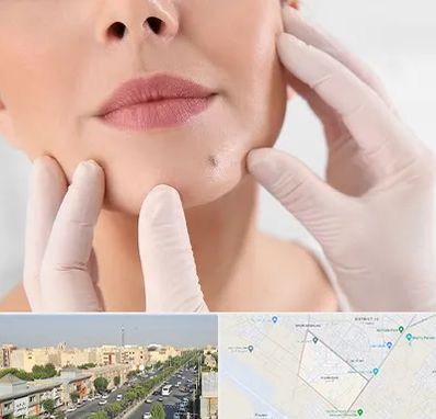 برداشتن خال در کیانمهر کرج