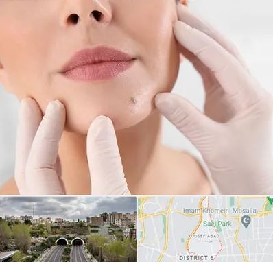 برداشتن خال در یوسف آباد 