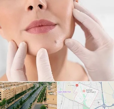 برداشتن خال در فاز سه اندیشه
