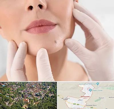 برداشتن خال در دماوند