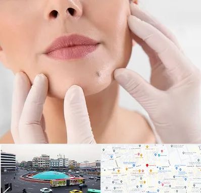 برداشتن خال در میدان انقلاب