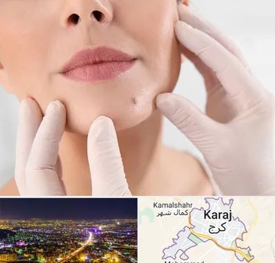 برداشتن خال در کرج