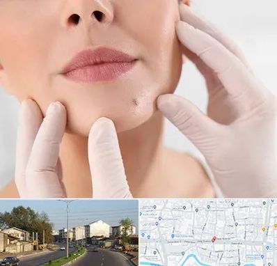 برداشتن خال در ضیابری رشت