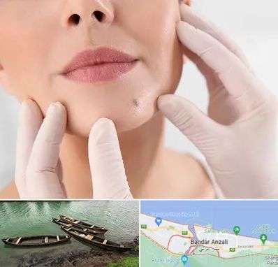 برداشتن خال در بندر انزلی