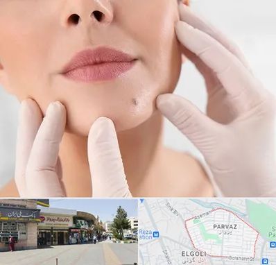 برداشتن خال در پرواز تبریز