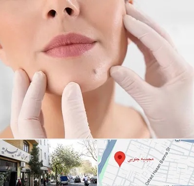 برداشتن خال در مجیدیه جنوبی