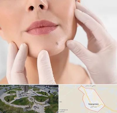 برداشتن خال در ورامین