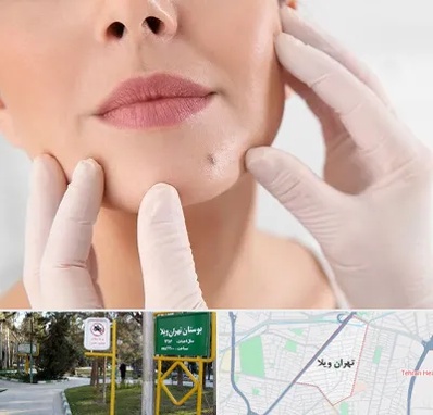 برداشتن خال در تهران ویلا