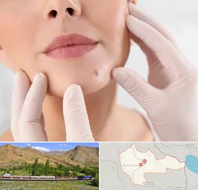 برداشتن خال در خاش