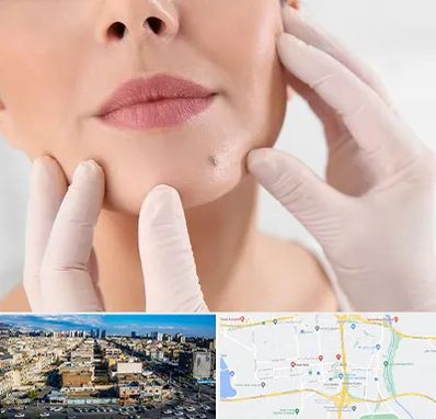 برداشتن خال در شهرک راه آهن