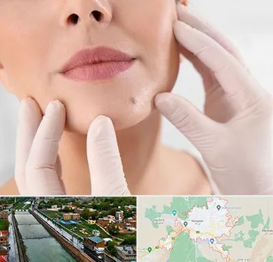 برداشتن خال در مراغه