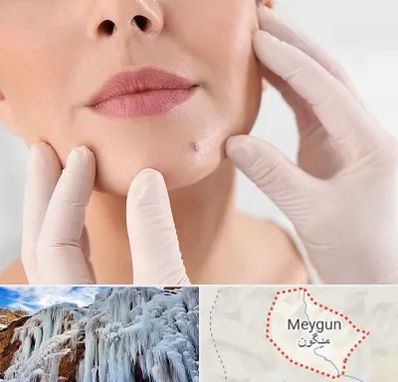 برداشتن خال در میگون