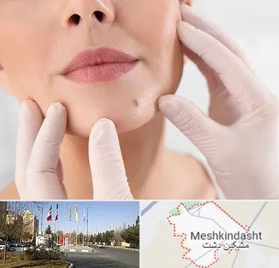 برداشتن خال در مشکین دشت