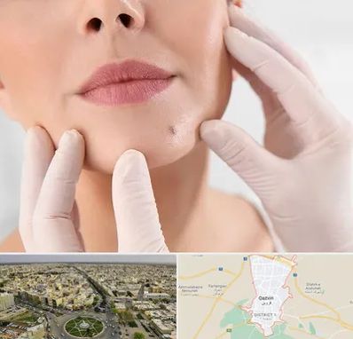 برداشتن خال در قزوین