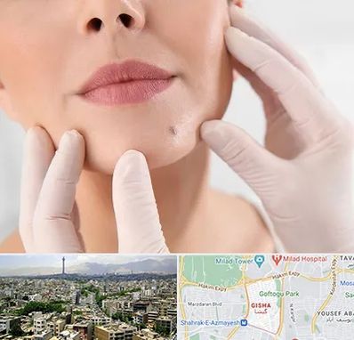 برداشتن خال در گیشا 