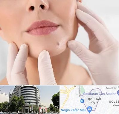 برداشتن خال در قلهک 