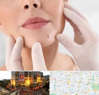 برداشتن خال در جنت آباد تهران 