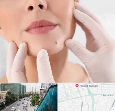 برداشتن خال در بلوار فرحزادی