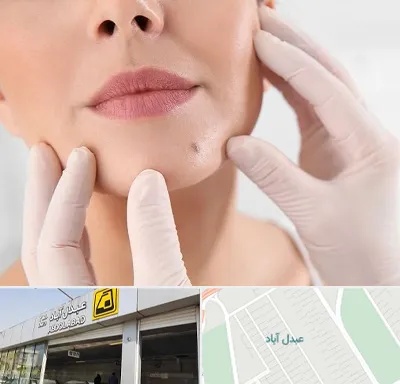 برداشتن خال در عبدل آباد
