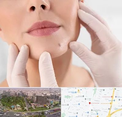 برداشتن خال در آیت الله کاشانی