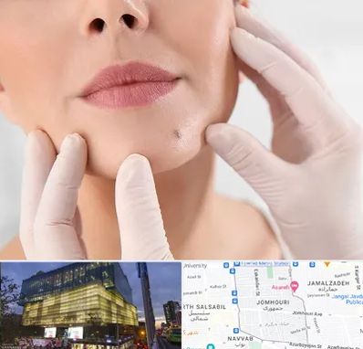 برداشتن خال در جمهوری 