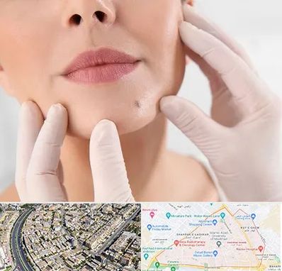 برداشتن خال در شهرک غرب مشهد