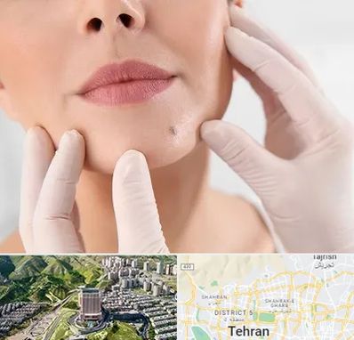 برداشتن خال در شمال تهران 