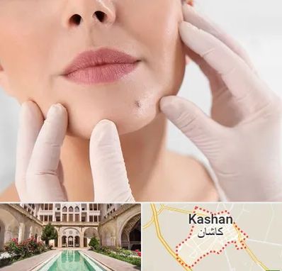 برداشتن خال در کاشان