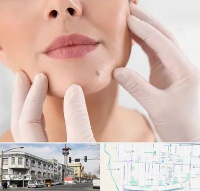 برداشتن خال در 17شهریور