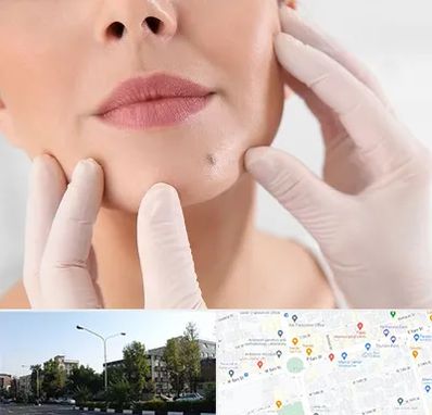 برداشتن خال در میدان کاج