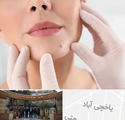 برداشتن خال در یاخچی آباد