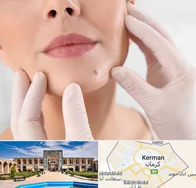 برداشتن خال در کرمان