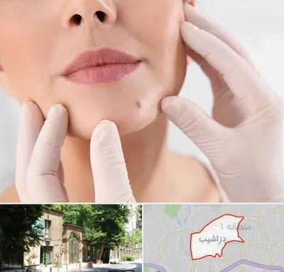 برداشتن خال در دزاشیب