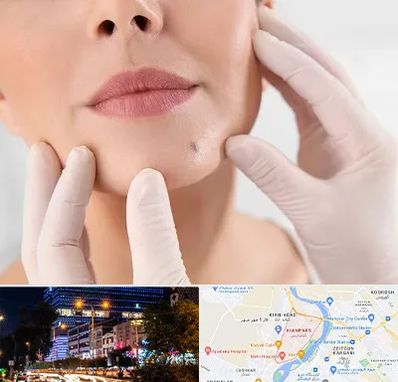 برداشتن خال در کیانپارس اهواز