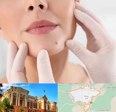 برداشتن خال در خوی