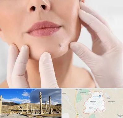 برداشتن خال در مرودشت