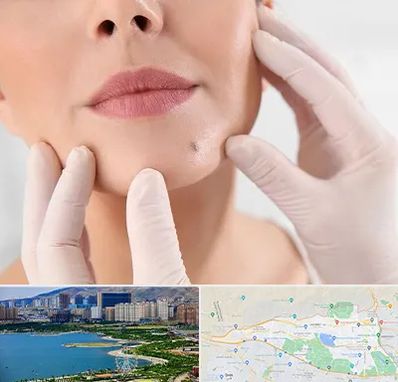 برداشتن خال در منطقه 22 تهران