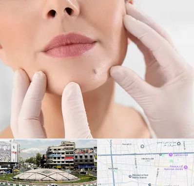 برداشتن خال در مرکز تهران