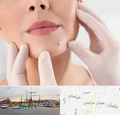 برداشتن خال در میدان خراسان