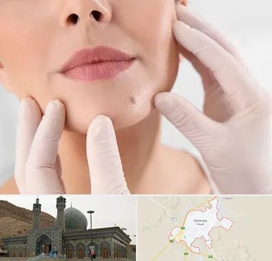 برداشتن خال در شهرضا