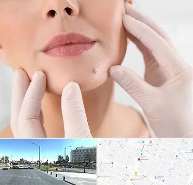 برداشتن خال در بلوار کلاهدوز مشهد