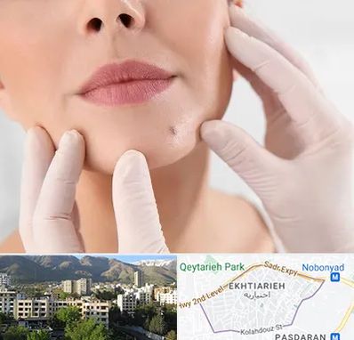 برداشتن خال در اختیاریه 